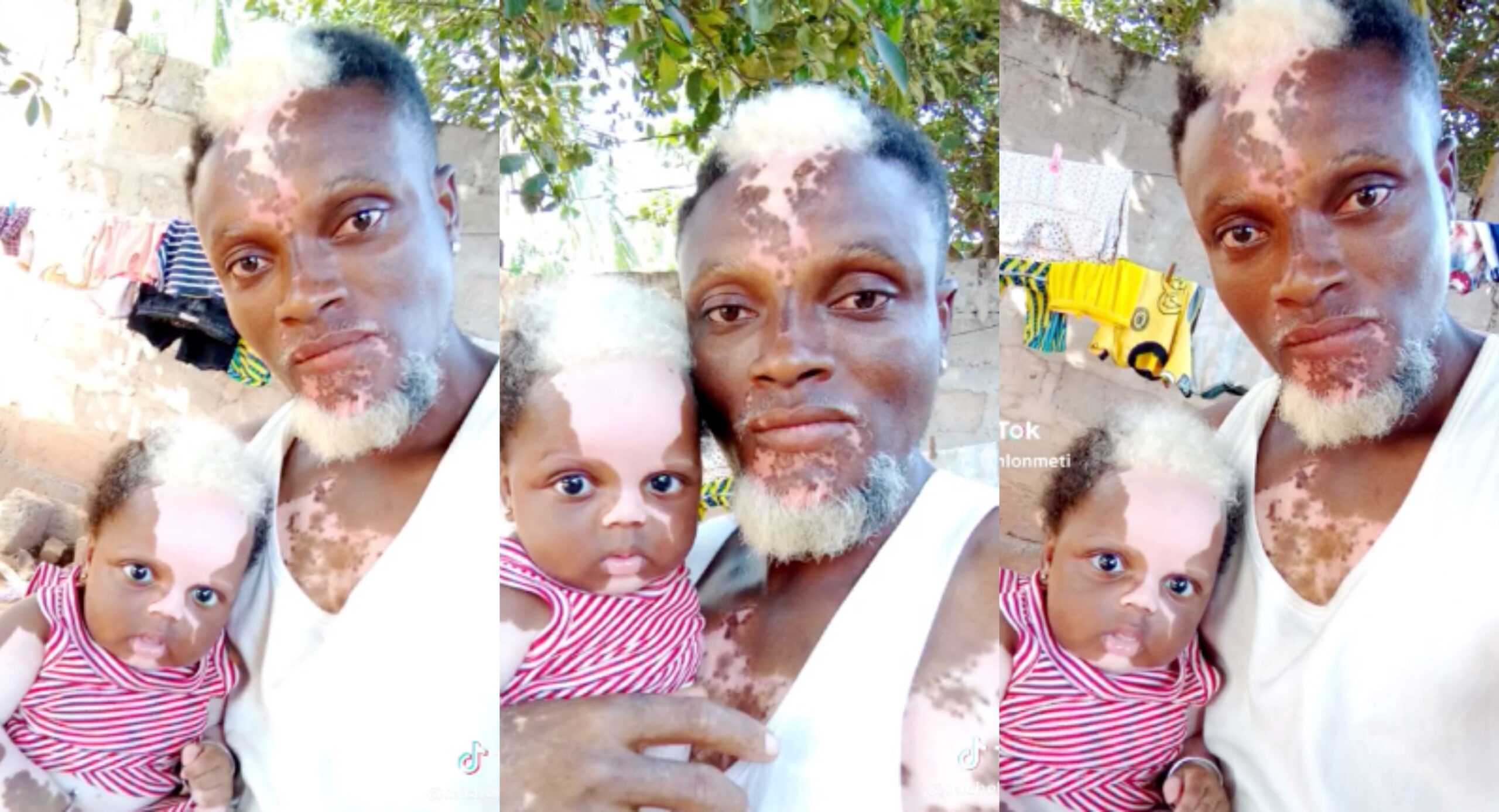 No need for DNA- Man and his daughter born with Vitiligo goes viral over resemblance (Video)