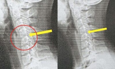 20-Year-Old Student Diagnosed With Text Neck After Excessive Phone Use