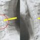 20-Year-Old Student Diagnosed With Text Neck After Excessive Phone Use