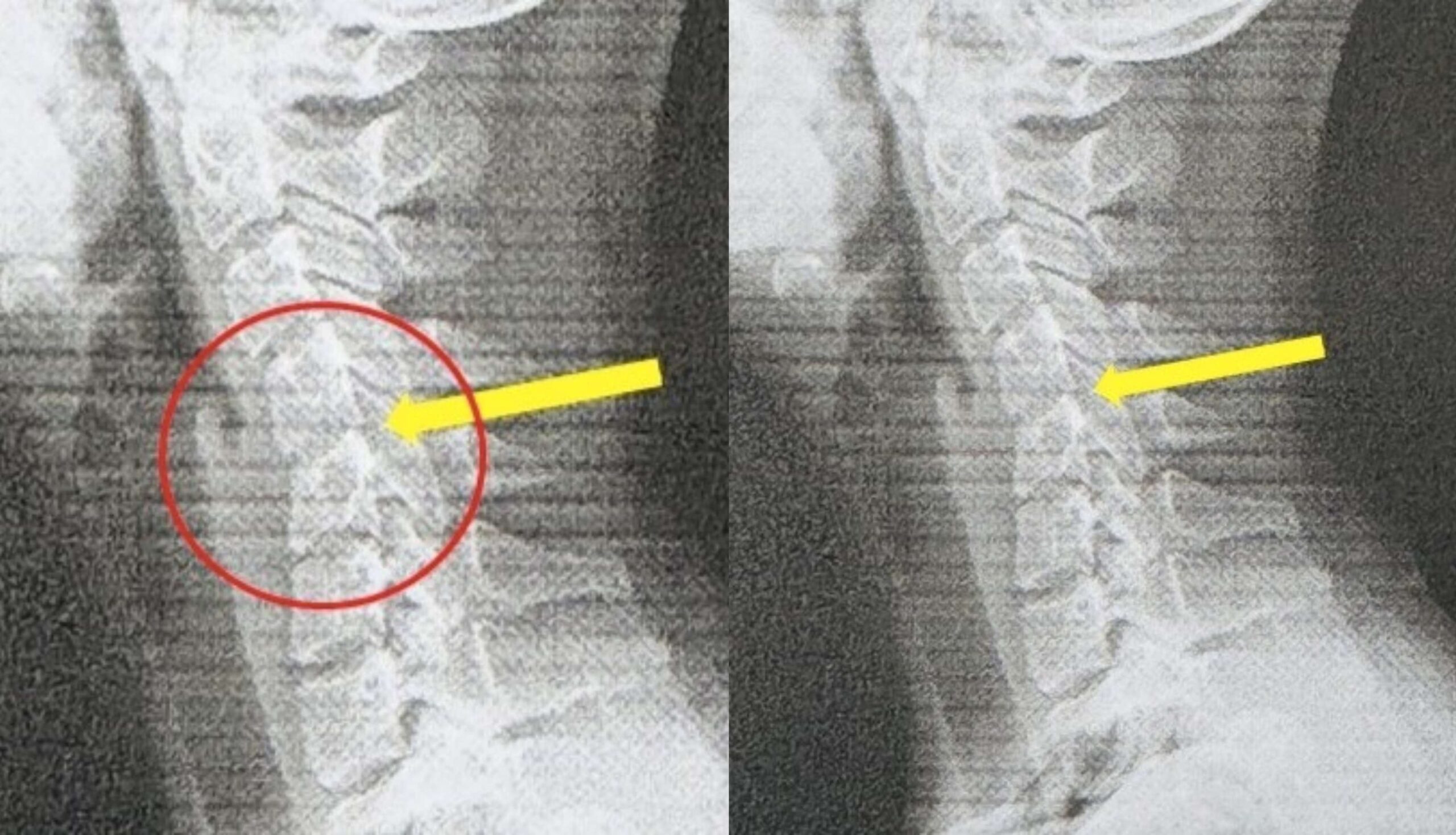 20-Year-Old Student Diagnosed With Text Neck After Excessive Phone Use