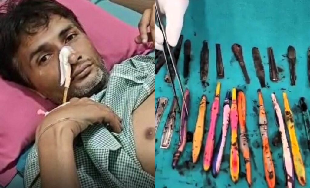 Doctors Remove 28 Spoons and 19 Toothbrushes from Man Stomach