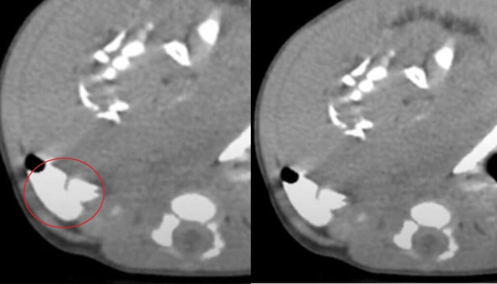 Newborn Baby Stuns Doctors After Parasitic Twin Is Found Growing Inside Her Stomach