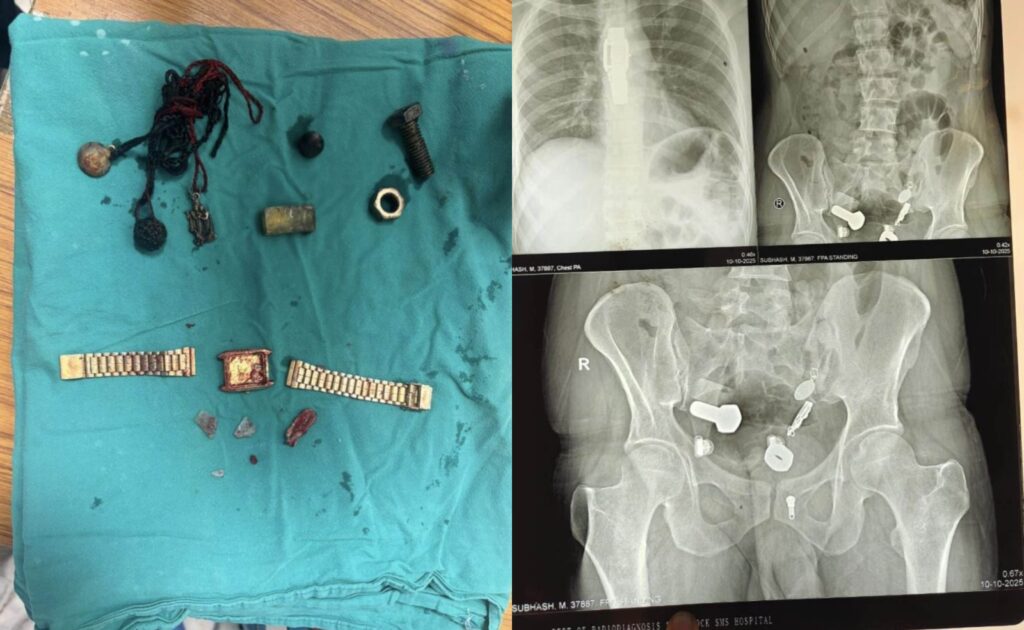 Doctors Stunned After Finding Wristwatch Inside Man Stomach During Surgery