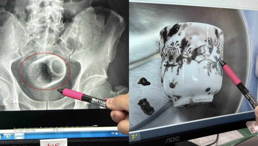 Doctors Remove Teacup From Man Butt After Suffering Severe Abdominal Pain