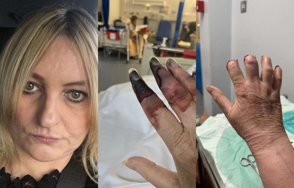 Woman Loses Fingers After Diagnosed with Minor Kidney Stone