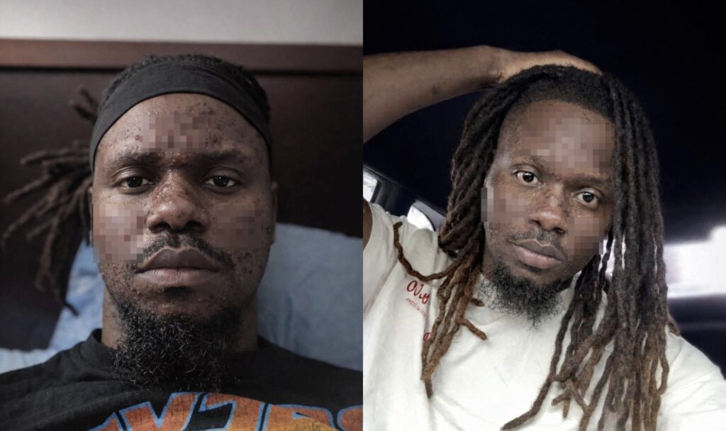 Man Shares How He Developed Pimples After Getting a Facial Treatment