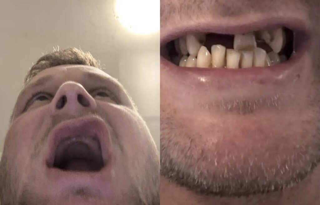 Man left with no teeth after traveling to Turkey for a teeth transplant