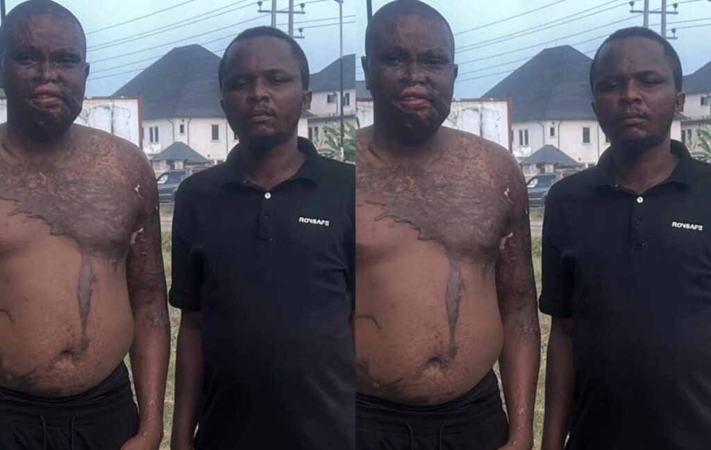 Man called out on social media for pouring acid on his brother
