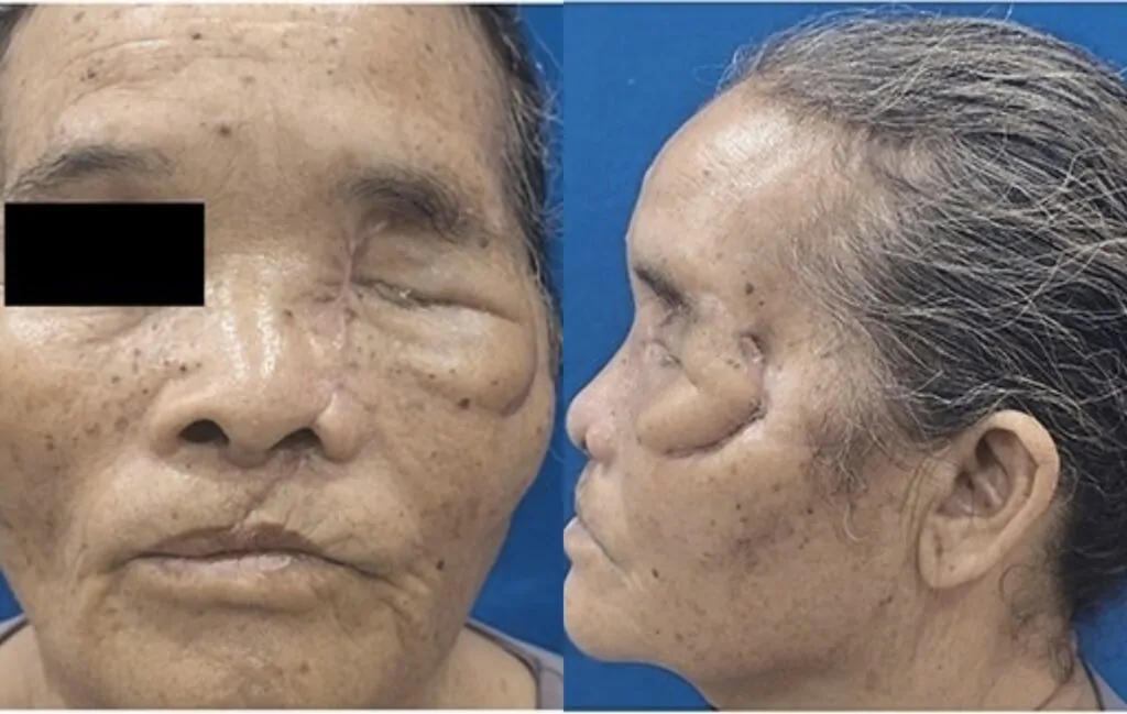 Woman loses part of her face after being attacked by a bear